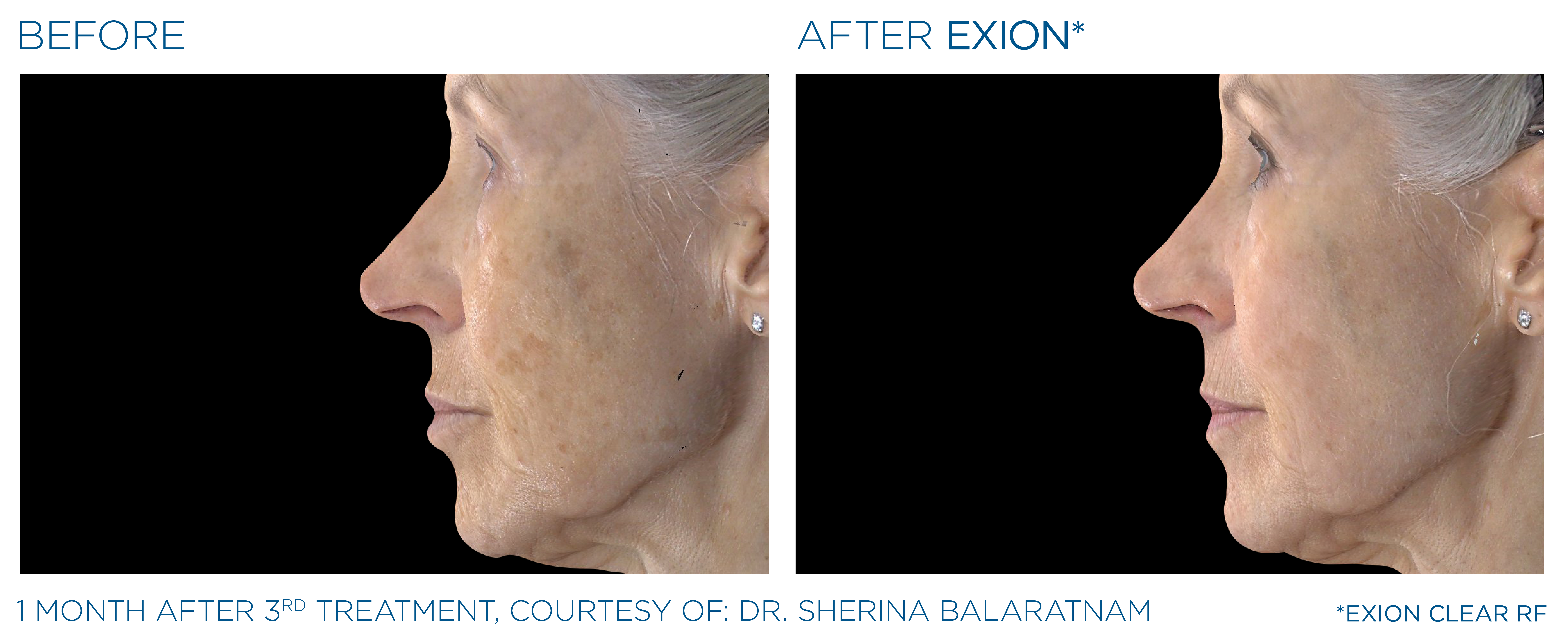 Exion Clear-RF Before and After — Example 2