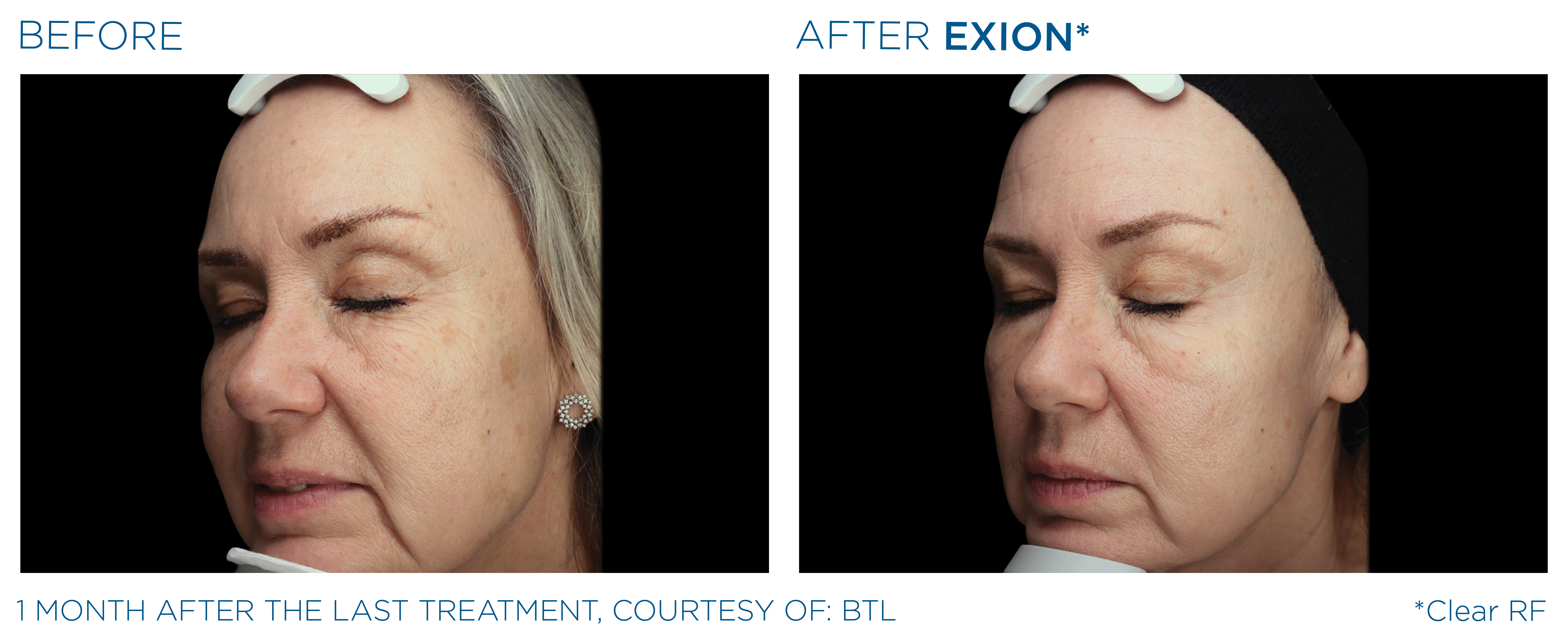 Exion Face Before and After — Example 1