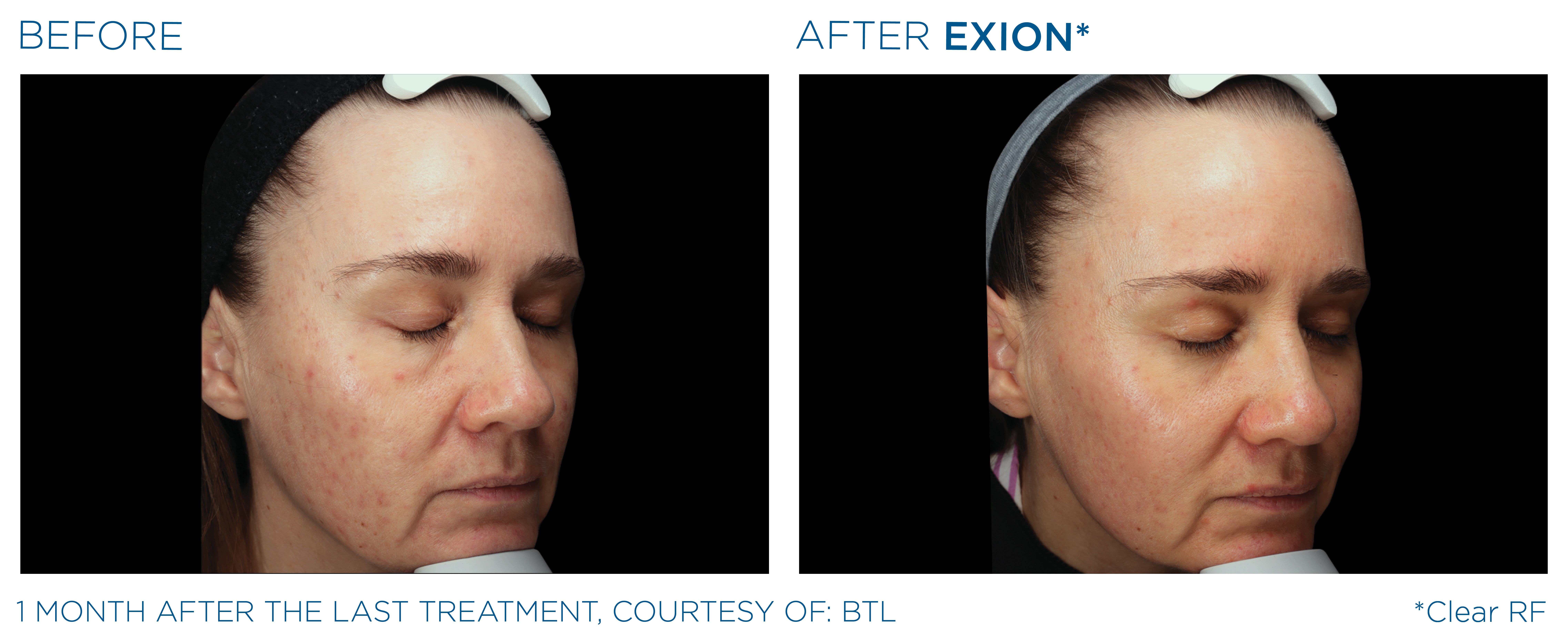 Exion Face Before and After — Example 2
