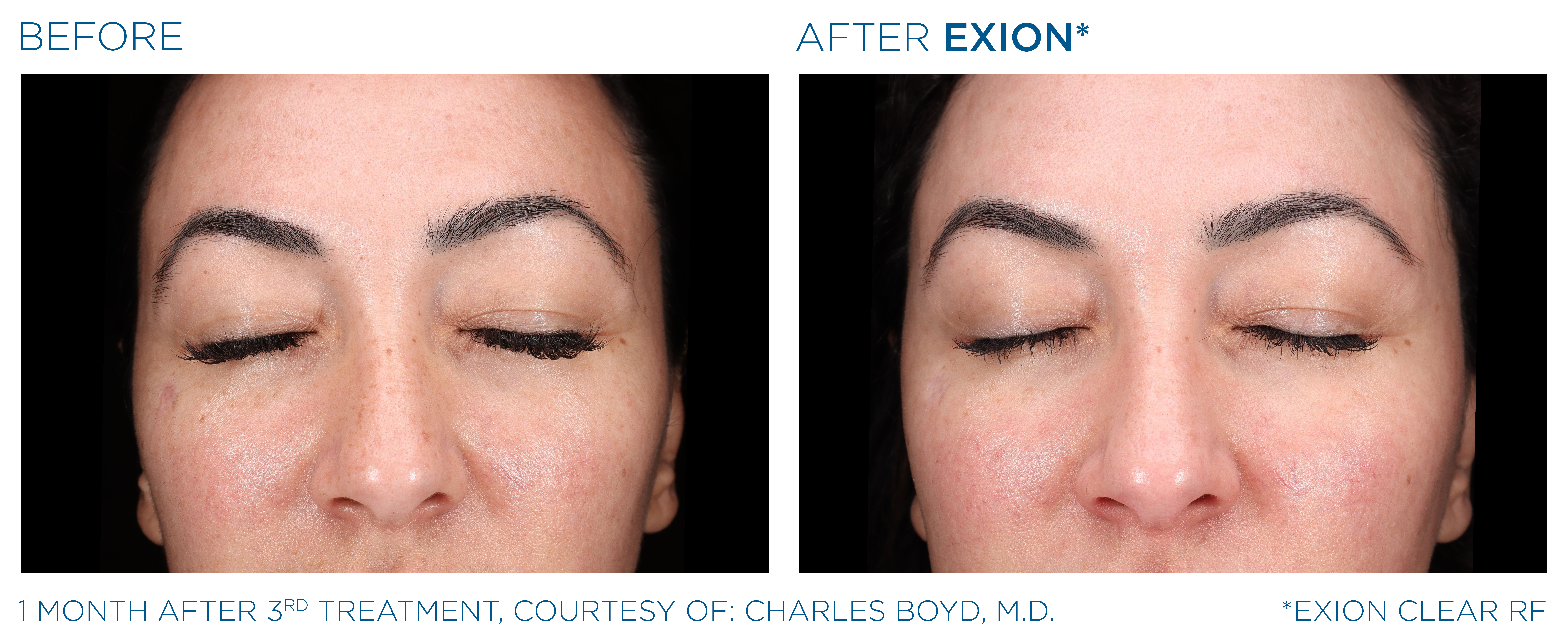 Exion Clear-RF Before and After — Example 1